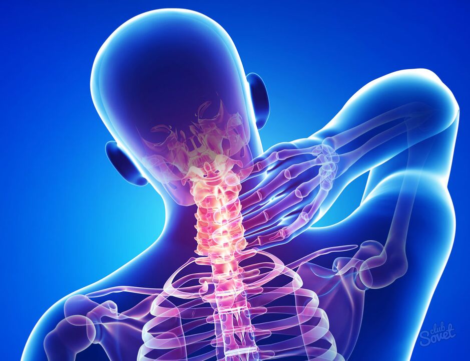 osteocondrose cervical