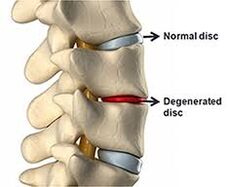 Disco normal da columna vertebral, disco danado