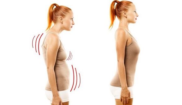 costas rectas e mala postura con osteocondrose cervical