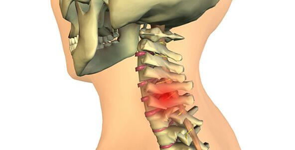 cambios na columna vertebral con osteocondrose cervical